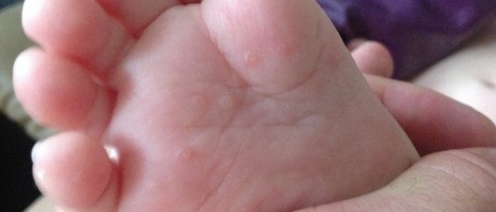 У ребенка потеют ладони и ступни причины – как избавиться от потных рук